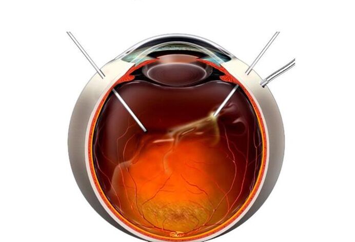 Vitrectomie une opération pour restaurer la vision