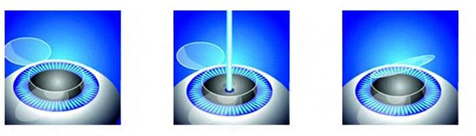 Étapes de la correction de la vision laser